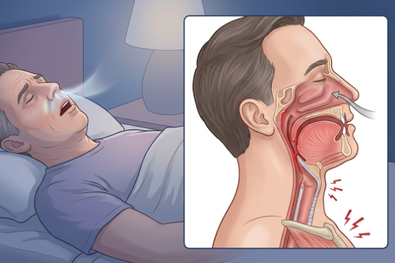 睡眠時無呼吸症候群（SAS）とは